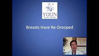 Can I Have Two Breast Lifts - Second Breast Lift Consultation - Dr. Anthony Youn