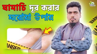 ঘামাচি দূর করার ঘরোয়া উপায়।