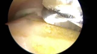 Arthroscopic Ankle ARTHRODESIS for Arthritis