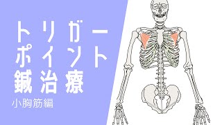 小胸筋のトリガーポイント鍼治療、肩関節の痛みに