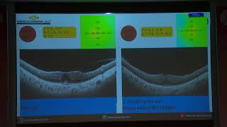 AIOC2022 FP1341   Vitreo Retinal Diseases   II topic  Idiopathic epiretinal membrane and its novel a