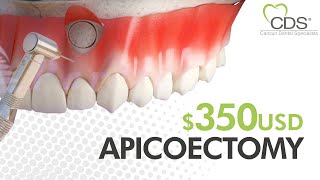 How Do You Perform an Apicoectomy in Mexico? | Cancun Dental Specialists