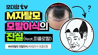 피콜로 더듬이 짤? M자탈모 모발이식하면 이렇게 된다?!😨