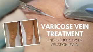 Endovenous Laser Ablation to treat Varicose Veins - Vein Health Vein Clinic