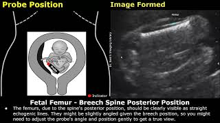 Fetal Femur Ultrasound Probe Positioning \u0026 Image Formation | FL USG Scanning Technique \u0026 Orientation