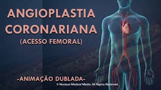 ANGIOPLASTIA CORONÁRIA  (Acesso Femoral) - Animação dublada