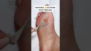Extreme Foot Peeling | How To Get Rid of Callused & Cracked Feet | Foot Peel Mask | Effective& Fast