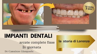 Come funziona l’ IMPLANTOLOGIA DENTALE