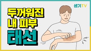 아토피와 착각하기 쉬운 태선, 증상과 종류