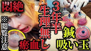 【閲覧注意　生理　吸い玉】瘀血ドバッ3年半無月経、瘀血ドロドロには吸い玉と鍼灸治療で治す　自分でできるツボもお伝えします　【鍼灸治療　銀座・横浜元町】