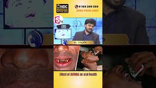 Impact Of Tobacco On Oral Health || Suman Tv Call Doctors || NDC