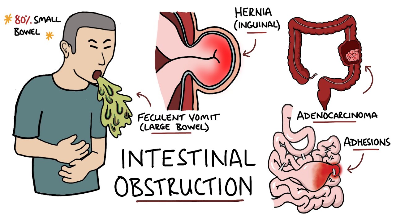 Intestinal Obstruction - Small Bowel Obstruction Vs Large Bowel ...