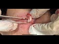 臉部粉瘤切除 美麗新城診所莊禮謙醫師 Minimal Incision, Epidermal Cyst, Great Healing, Dr George