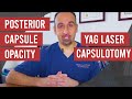 Posterior Capsule Opacity and Yag Laser Capsulotomy