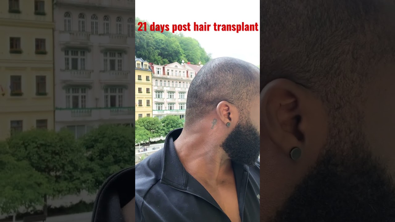 21 Days Post Hair Transplant. Asli Tarcan 5,000 Graphs DHI. - YouTube