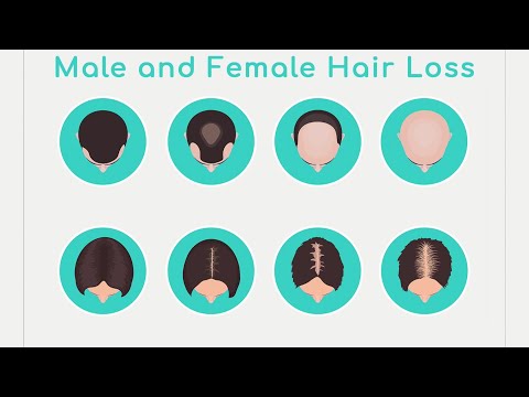 About hormonal hair loss and why hair says a lot about hormones