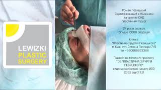 Пластична операція ринопластика І Центр пластичної хірургії м. Київ І Хірург Роман Левицький