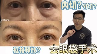 ️️去眼袋手術 人生不後悔系列之一｜醫美診所如何安全操作｜360全方位醫美診所