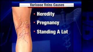 Quick Fix Can Help Ease Pain Of Varicose Veins