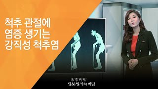 척추 관절에 염증 생기는 강직성 척추염 - (20130309_451회 방송)_젊은 허리를 노린다, 강직성 척추염