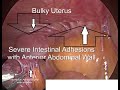 Laparoscopic TLH for Previous Multiple Surgeries and Severe Intestinal Adhesions By Dr.Pragnesh Shah