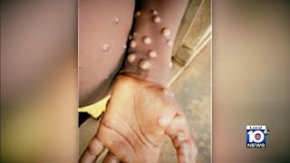 Broward County reports most monkeypox cases in the state