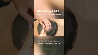 韓國永長專業植髮醫院，混合式4800毛植髮效果 #hairtransplantsurgery #韩国植发医院 #永長植髮 #毛髮移植 #永长植发 #fue #植发 #植髮 #fut #韓國免剃發植髮