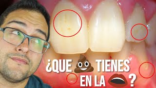 ¿Que es la PLACA DENTAL, SARRO y MATERIA ALBA? como PREVENIRLOS 😀😀😀😀