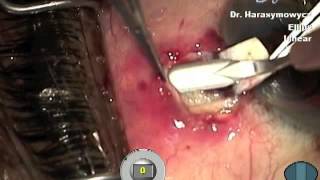 Deep sclerectomy with gold mini-shunt outcomes positive at 1 year