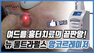 여드름흉터 치료! 여기 흉터치료의 끝판왕 레이저가 있습니다. / 여드름흉터 레이저 흉터치료 앙코르레이저 울트라펄스앙코르레이저