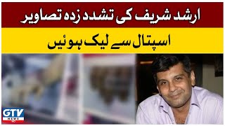 Tortured Pictures of Arshad Sharif were Leaked from Hospital | Arshad Sharif Case Updates