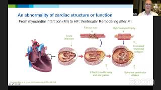 28° Virtual Meeting - Dispostivos de Assistência Ventricular - Dr. Volkmar Falk