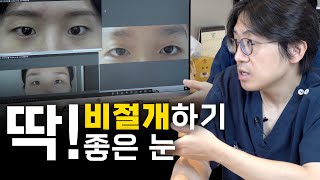 온라인 성형 상담ㅣ비절개는 이런 눈에 하는 겁니다