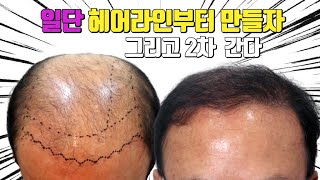 대머리모발이식 고도탈모 대량모발이식 or 2차 모발이식 당신의 선택은?