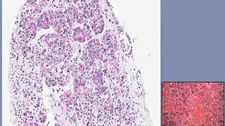 Surgical Pathology - Craniopharyngioma | UCLA Pituitary Tumor Program