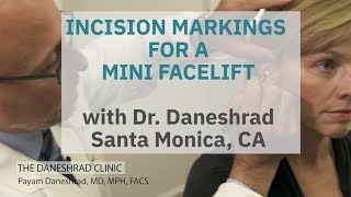 Where Are Incision Lines for a Mini Facelift? Dr. Daneshrad's Approach