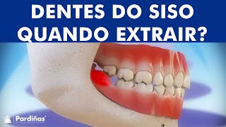 Pericoronarite e extração de dentes do siso ©