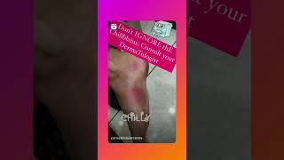 Don't ignore your Chillblains winter season#shorts #youtubeshorts|Chilblains treatment in chandigarh