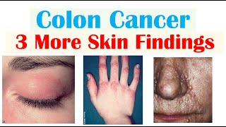 Colon Cancer: 3 Other Weird Symptoms (Found on the Skin)