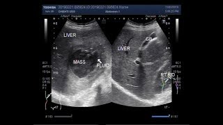 Ultrasound Video showing Amoebic liver abscess.