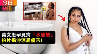 碰水就灼熱發癢 英女患罕見病 「水過敏」拍片揭沖涼超痛苦