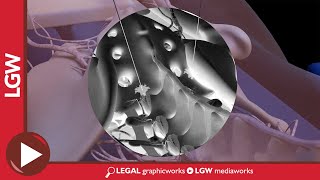 Lumbar Facet Injections L4 5, L5 S1 3D Animation