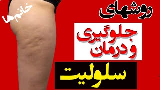 جلوگیری و درمان سلولیت | توده های چربی زیر پوست خانم ها