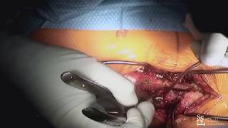Lumbar Fusion - live surgery with Rod Oskouian, MD⠀