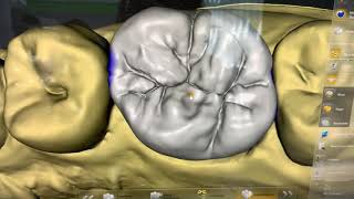 Designing Upper First Molar using Sirona Cadcam | Giezi Heart