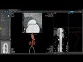 vitrea demonstrations transcatheter aortic valve replacement tavr