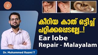 കീറിയ കാത് ഒട്ടിച്ച് പറ്റിക്കപ്പെടല്ലേ! | Ear lobe repair - Malayalam | Dr Razmi