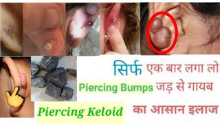 Piercing Keloid गायब करने का आसान व घरेलू उपाय l  Home remedies for piercing keloid l Piercing Tips
