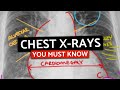 10 MUST KNOW Chest X-Rays For Medical/PA Finals | CXRs Made Easy