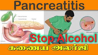 Pancreatitis கணைய அழற்சி Symtpoms treatment prevention reasons hospital udumalpet tamil  alcohol